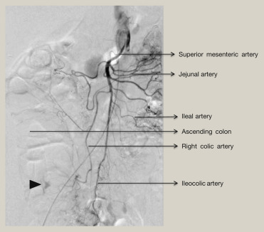 Peripheral Arterial Disease (PAD)
