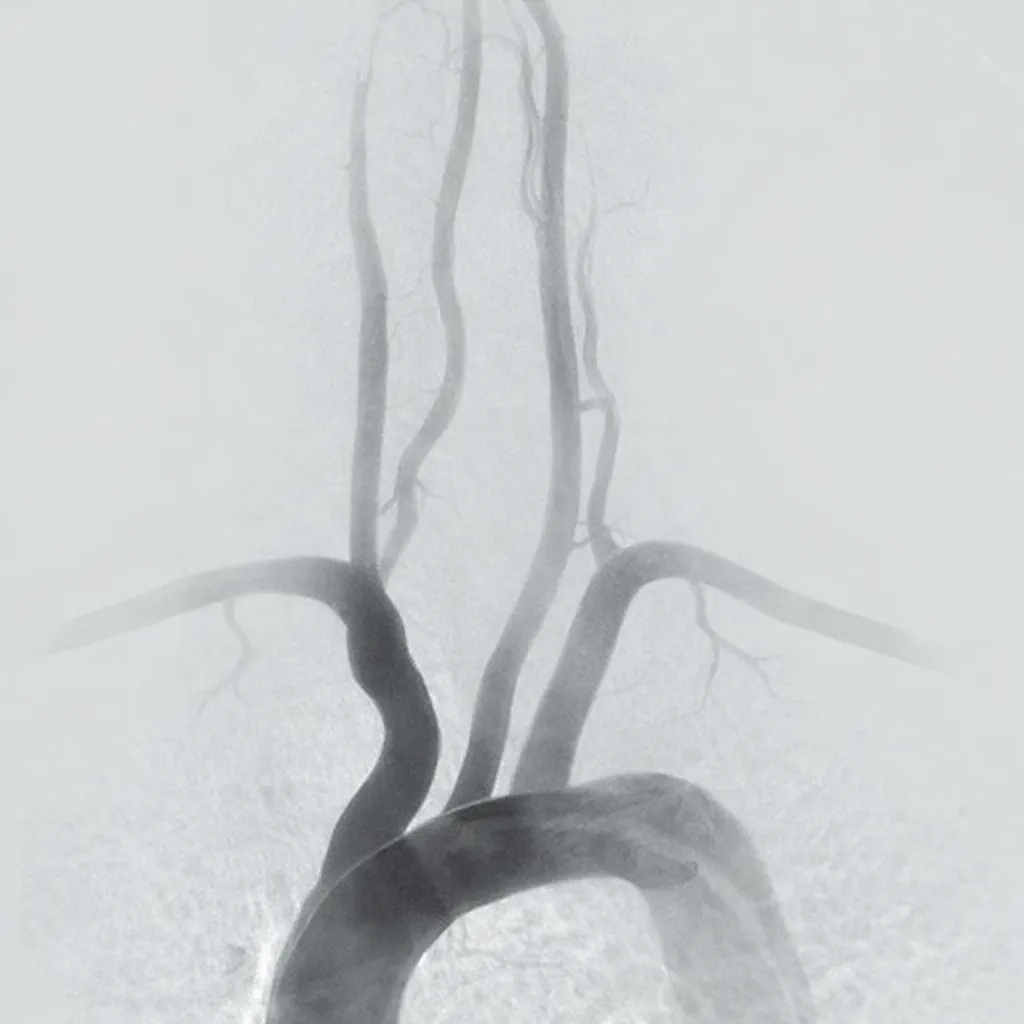 Aortic arch angiogram