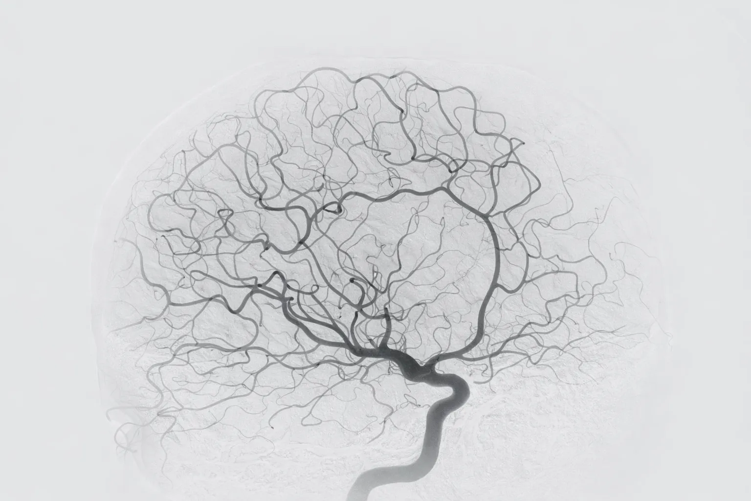 Cerebral angiogram